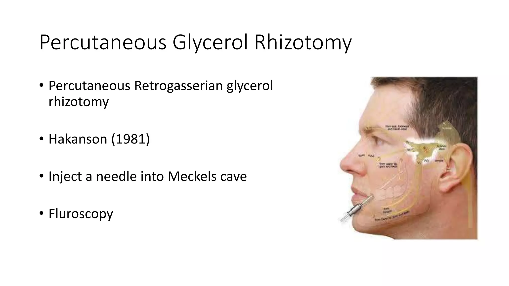Trigeminal Neuralgia.pptx