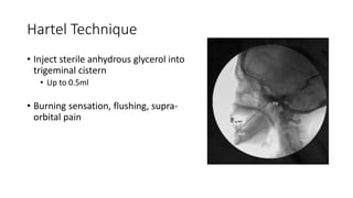 Hartel Technique
• Inject sterile anhydrous glycerol into
trigeminal cistern
• Up to 0.5ml
• Burning sensation, flushing, supra-
orbital pain
 