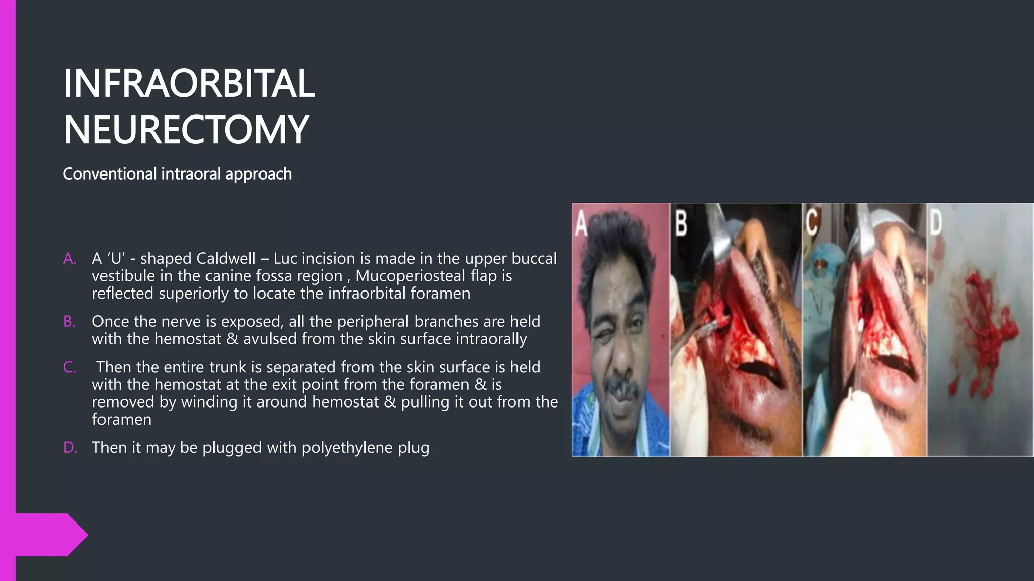 INFRAORBITAL
NEURECTOMY
Conventional intraoral approach
A. A ‘U’ - shaped Caldwell – Luc incision is made in the upper buccal
vestibule in the canine fossa region , Mucoperiosteal flap is
reflected superiorly to locate the infraorbital foramen
B. Once the nerve is exposed, all the peripheral branches are held
with the hemostat & avulsed from the skin surface intraorally
C. Then the entire trunk is separated from the skin surface is held
with the hemostat at the exit point from the foramen & is
removed by winding it around hemostat & pulling it out from the
foramen
D. Then it may be plugged with polyethylene plug
 