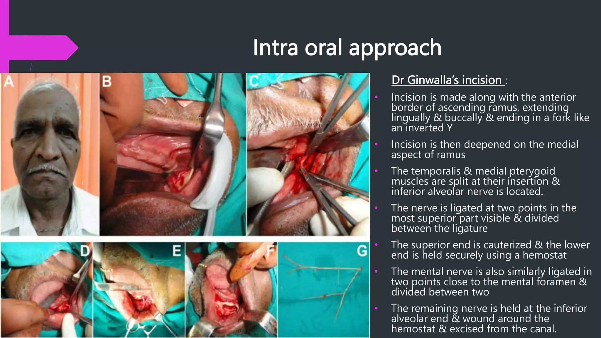 Intra oral approach
Dr Ginwalla’s incision :
• Incision is made along with the anterior
border of ascending ramus, extending
lingually & buccally & ending in a fork like
an inverted Y
• Incision is then deepened on the medial
aspect of ramus
• The temporalis & medial pterygoid
muscles are split at their insertion &
inferior alveolar nerve is located.
• The nerve is ligated at two points in the
most superior part visible & divided
between the ligature
• The superior end is cauterized & the lower
end is held securely using a hemostat
• The mental nerve is also similarly ligated in
two points close to the mental foramen &
divided between two
• The remaining nerve is held at the inferior
alveolar end & wound around the
hemostat & excised from the canal.
 