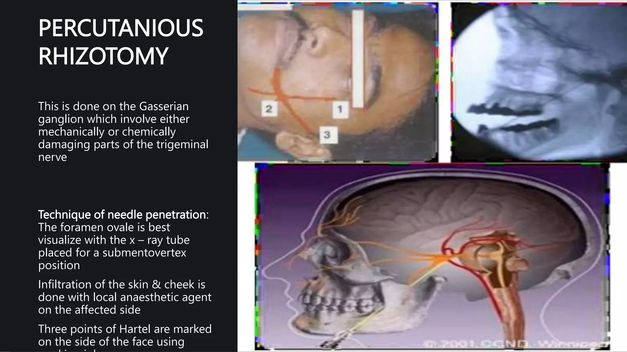 PERCUTANIOUS
RHIZOTOMY
This is done on the Gasserian
ganglion which involve either
mechanically or chemically
damaging parts of the trigeminal
nerve
Technique of needle penetration:
The foramen ovale is best
visualize with the x – ray tube
placed for a submentovertex
position
Infiltration of the skin & cheek is
done with local anaesthetic agent
on the affected side
Three points of Hartel are marked
on the side of the face using
 