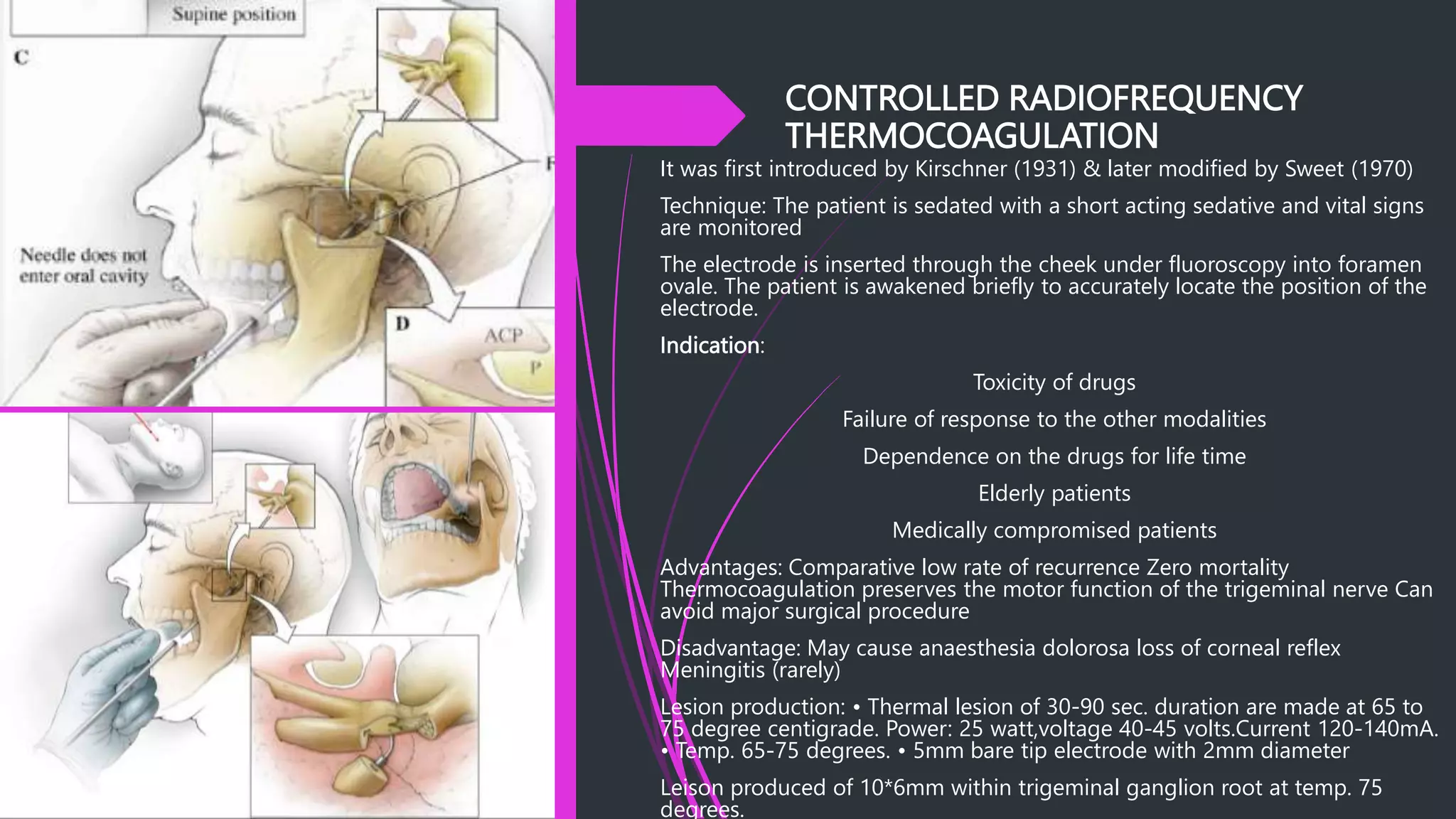 CONTROLLED RADIOFREQUENCY
THERMOCOAGULATION
It was first introduced by Kirschner (1931) & later modified by Sweet (1970)
Technique: The patient is sedated with a short acting sedative and vital signs
are monitored
The electrode is inserted through the cheek under fluoroscopy into foramen
ovale. The patient is awakened briefly to accurately locate the position of the
electrode.
Indication:
Toxicity of drugs
Failure of response to the other modalities
Dependence on the drugs for life time
Elderly patients
Medically compromised patients
Advantages: Comparative low rate of recurrence Zero mortality
Thermocoagulation preserves the motor function of the trigeminal nerve Can
avoid major surgical procedure
Disadvantage: May cause anaesthesia dolorosa loss of corneal reflex
Meningitis (rarely)
Lesion production: • Thermal lesion of 30-90 sec. duration are made at 65 to
75 degree centigrade. Power: 25 watt,voltage 40-45 volts.Current 120-140mA.
• Temp. 65-75 degrees. • 5mm bare tip electrode with 2mm diameter
Leison produced of 10*6mm within trigeminal ganglion root at temp. 75
degrees.
 