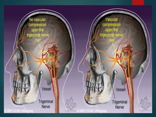 Trigeminal Neuralgia and its complications | PPT