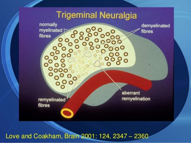 Trileptal For Ms Pain