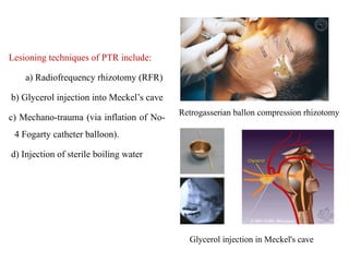 Trigeminal Neuralgia & Microvascular Decompression(MVD).pptx