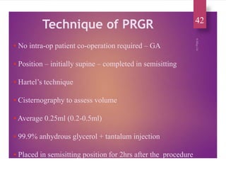 Trigeminal neuralgia praveen | PPTX