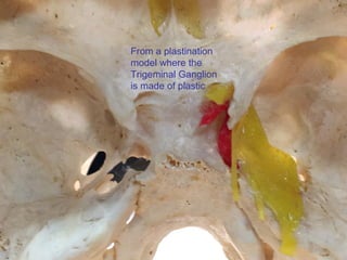 From a plastination
model where the
Trigeminal Ganglion
is made of plastic
 