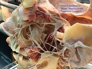 From a plastination
Model, showing a real
Trigeminal Ganglion
 
