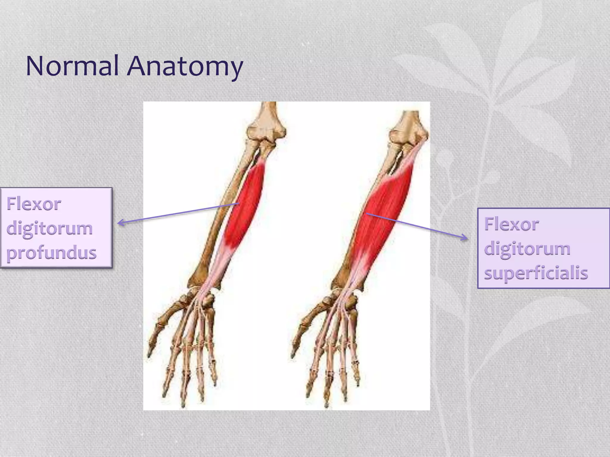 Normal Anatomy
Flexor
digitorum
profundus
Flexor
digitorum
superficialis
 