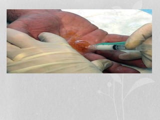 Investigations
• injection of lidocaine into the flexor sheath relieve the pain +
allow the digit to become actively or passively extended.
• no role for imaging
• x-rays considered unnecessary in patients without history of
inflammatory disease or trauma
 