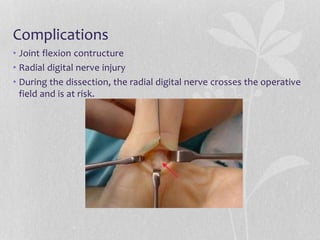 Complications
• Joint flexion contructure
• Radial digital nerve injury
• During the dissection, the radial digital nerve crosses the operative
field and is at risk.
 