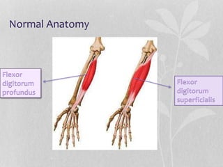 Normal Anatomy
Flexor
digitorum
profundus
Flexor
digitorum
superficialis
 