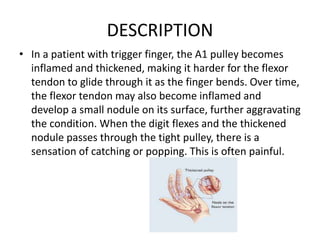 DESCRIPTION
• In a patient with trigger finger, the A1 pulley becomes
inflamed and thickened, making it harder for the flexor
tendon to glide through it as the finger bends. Over time,
the flexor tendon may also become inflamed and
develop a small nodule on its surface, further aggravating
the condition. When the digit flexes and the thickened
nodule passes through the tight pulley, there is a
sensation of catching or popping. This is often painful.
 