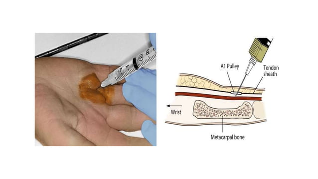 Trigger Finger - with glucocorticoid injection | PPT
