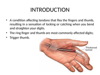 INTRODUCTION
• A condition affecting tendons that flex the fingers and thumb,
resulting in a sensation of locking or catching when you bend
and straighten your digits.
• The ring finger and thumb are most commonly affected digits;
• Trigger thumb.
 