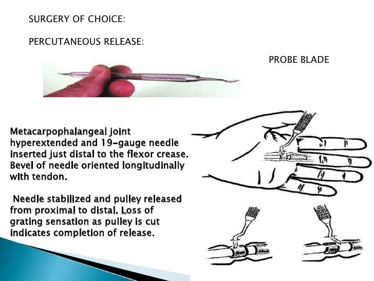 How do you know if you need trigger finger surgery?