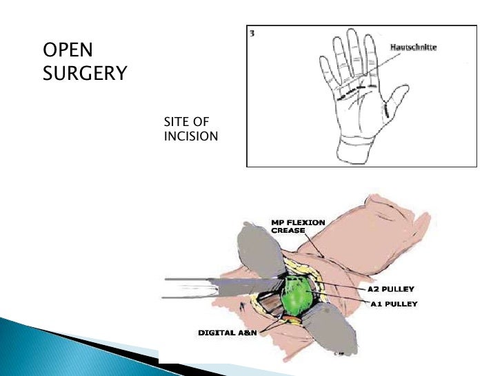 Trigger Finger Surgery Recovery: What to Expect