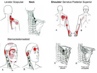 Trigger point 3a | PPT