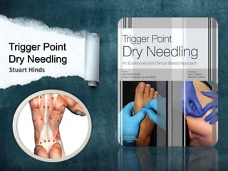 Trigger Point
Dry Needling
Stuart Hinds

 