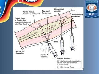 Trigger Point Injection Material Trigger point injection | PPTX
