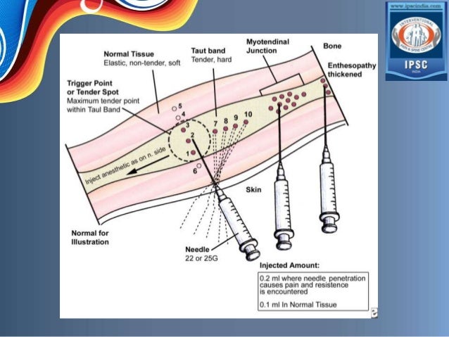 SEARCH AND BUY THIS PRODUCT Trigger point injection