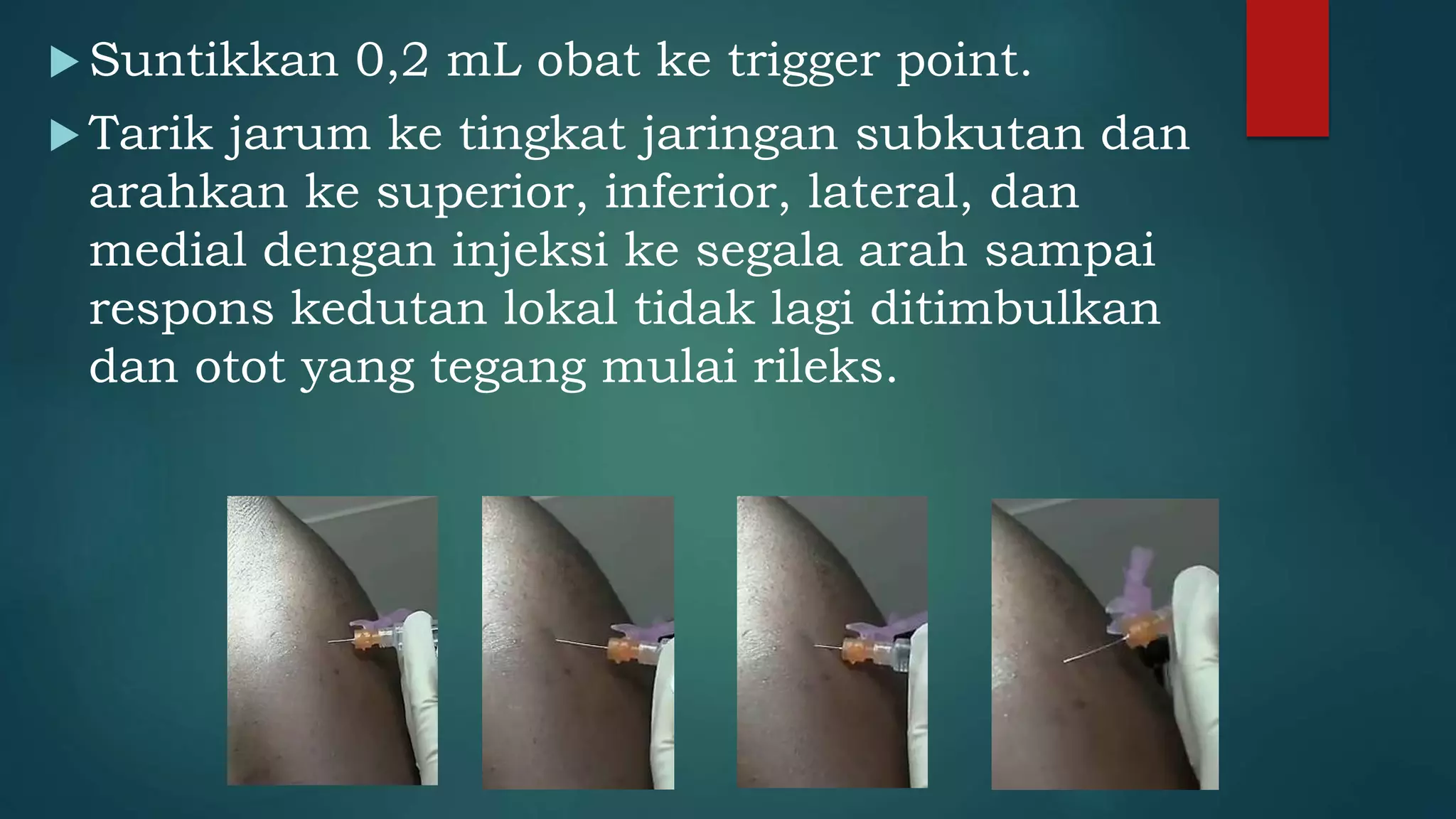 Tpi Injection Disguised TRIGGER POINT INJECTION (TPI) MHD.pptx