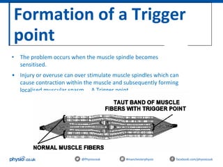 Formation of a Trigger
point
@Physiocouk #manchesterphysio facebook.com/physiocouk
• The problem occurs when the muscle spindle becomes
sensitised.
• Injury or overuse can over stimulate muscle spindles which can
cause contraction within the muscle and subsequently forming
localised muscular spasm…. A Trigger point.
 