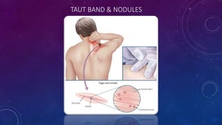 TAUT BAND & NODULES
 