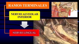 NERVIO ALVEOLAR
INFERIOR
NERVIO LINGUAL
RAMOS TERMINALES
 