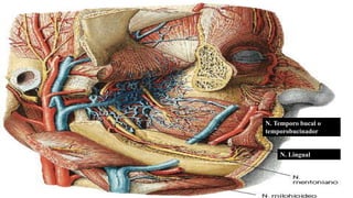 N. Lingual
N. Temporo bucal o
temporobucinador
N. Lingual
 