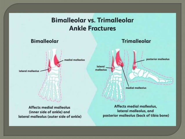 Trimalleolar Fracture.pptx. . PPT