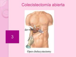Colecistectomía abierta




3
 