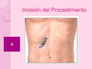 Incisión del Procedimiento




4
 