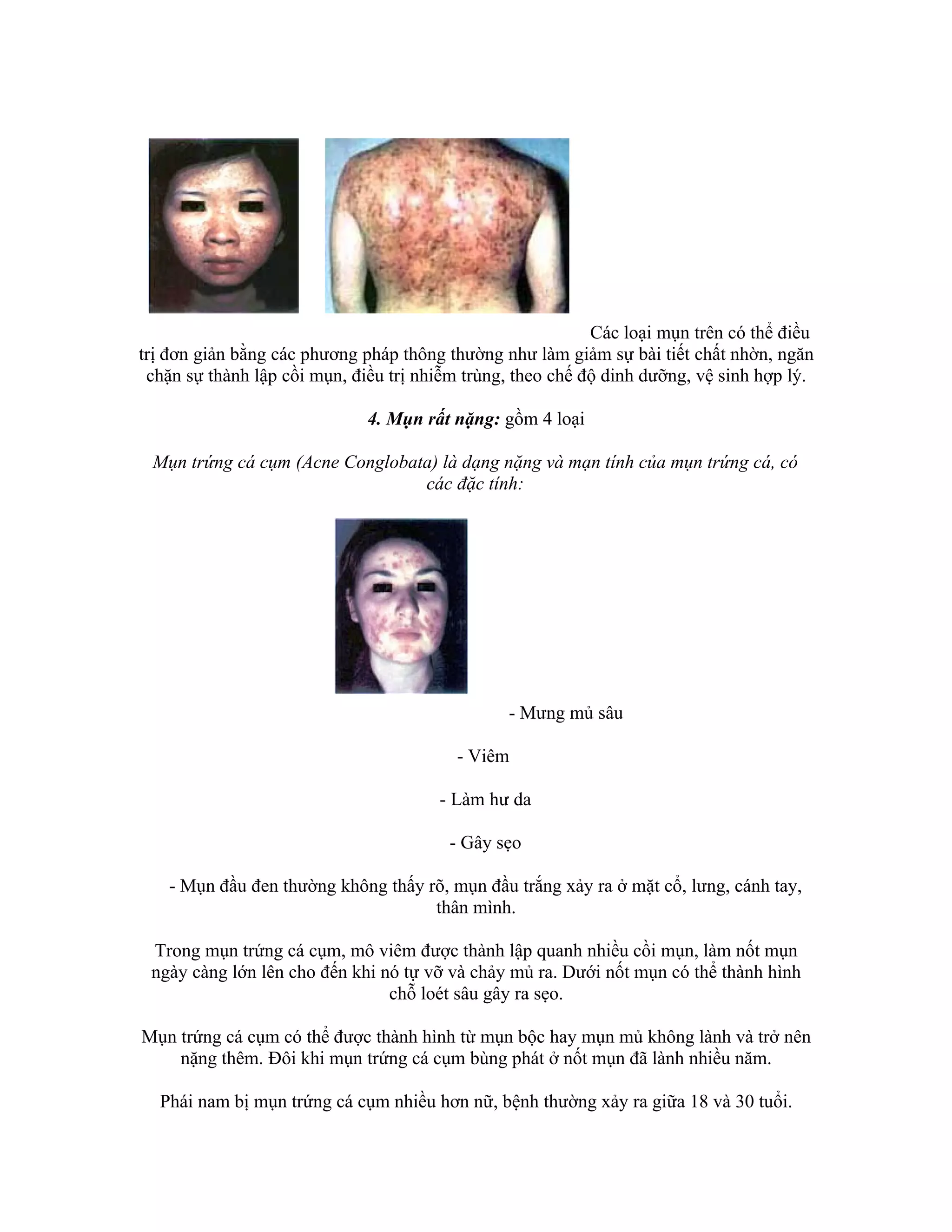 Các loại mụn trên có thể điều
trị đơn giản bằng các phương pháp thông thường như làm giảm sự bài tiết chất nhờn, ngăn
 chặn sự thành lập cồi mụn, điều trị nhiễm trùng, theo chế độ dinh dưỡng, vệ sinh hợp lý.

                              4. Mụn rất nặng: gồm 4 loại

 Mụn trứng cá cụm (Acne Conglobata) là dạng nặng và mạn tính của mụn trứng cá, có
                                 các đặc tính:




                                                - Mưng mủ sâu

                                         - Viêm

                                       - Làm hư da

                                        - Gây sẹo

   - Mụn đầu đen thường không thấy rõ, mụn đầu trắng xảy ra ở mặt cổ, lưng, cánh tay,
                                    thân mình.

 Trong mụn trứng cá cụm, mô viêm được thành lập quanh nhiều cồi mụn, làm nốt mụn
 ngày càng lớn lên cho đến khi nó tự vỡ và chảy mủ ra. Dưới nốt mụn có thể thành hình
                                chỗ loét sâu gây ra sẹo.

Mụn trứng cá cụm có thể được thành hình từ mụn bộc hay mụn mủ không lành và trở nên
    nặng thêm. Đôi khi mụn trứng cá cụm bùng phát ở nốt mụn đã lành nhiều năm.

  Phái nam bị mụn trứng cá cụm nhiều hơn nữ, bệnh thường xảy ra giữa 18 và 30 tuổi.
 