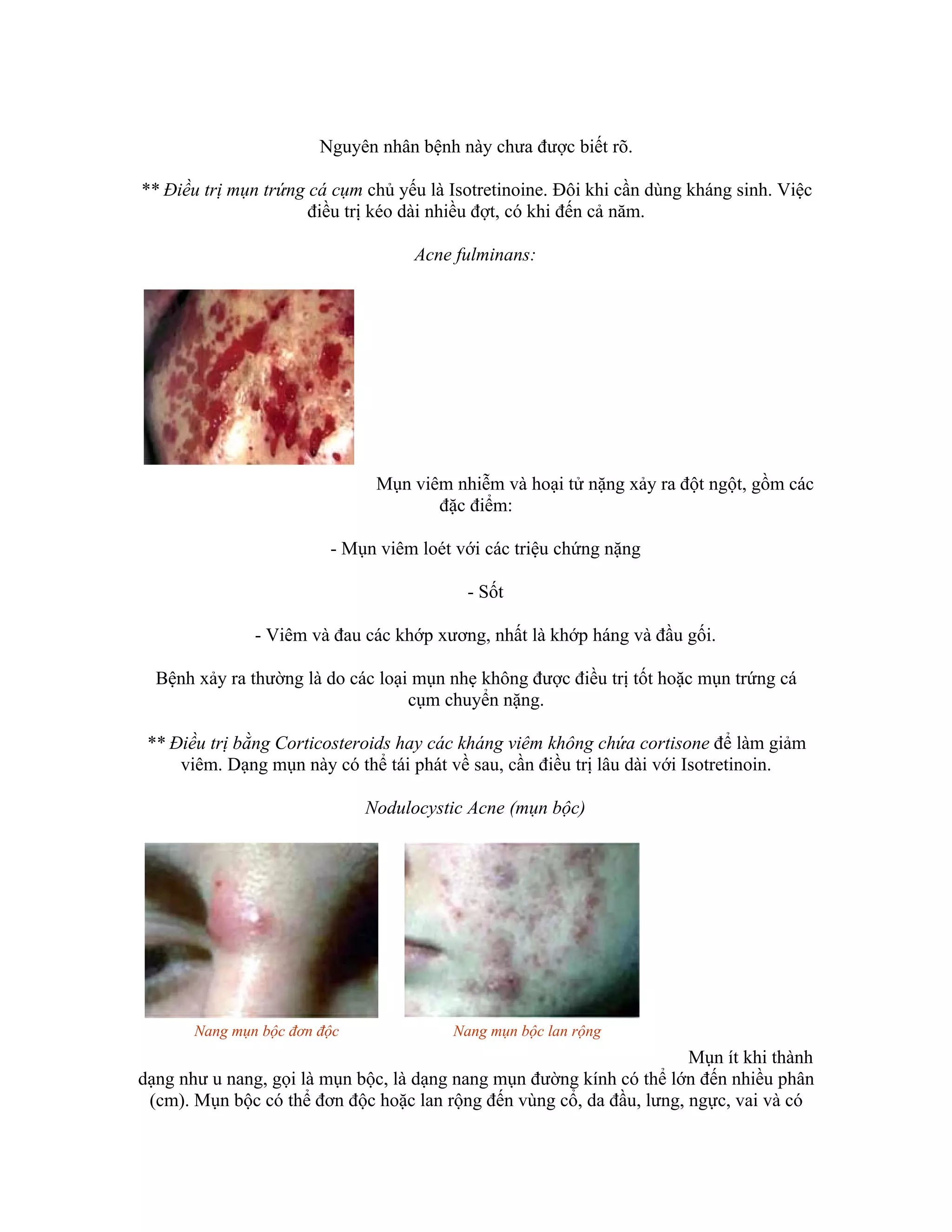 Nguyên nhân bệnh này chưa được biết rõ.

** Điều trị mụn trứng cá cụm chủ yếu là Isotretinoine. Đôi khi cần dùng kháng sinh. Việc
                      điều trị kéo dài nhiều đợt, có khi đến cả năm.

                                    Acne fulminans:




                               Mụn viêm nhiễm và hoại tử nặng xảy ra đột ngột, gồm các
                                      đặc điểm:

                         - Mụn viêm loét với các triệu chứng nặng

                                           - Sốt

               - Viêm và đau các khớp xương, nhất là khớp háng và đầu gối.

  Bệnh xảy ra thường là do các loại mụn nhẹ không được điều trị tốt hoặc mụn trứng cá
                                   cụm chuyển nặng.

 ** Điều trị bằng Corticosteroids hay các kháng viêm không chứa cortisone để làm giảm
     viêm. Dạng mụn này có thể tái phát về sau, cần điều trị lâu dài với Isotretinoin.

                              Nodulocystic Acne (mụn bộc)




       Nang mụn bộc đơn độc              Nang mụn bộc lan rộng
                                                                       Mụn ít khi thành
dạng như u nang, gọi là mụn bộc, là dạng nang mụn đường kính có thể lớn đến nhiều phân
 (cm). Mụn bộc có thể đơn độc hoặc lan rộng đến vùng cổ, da đầu, lưng, ngực, vai và có
 