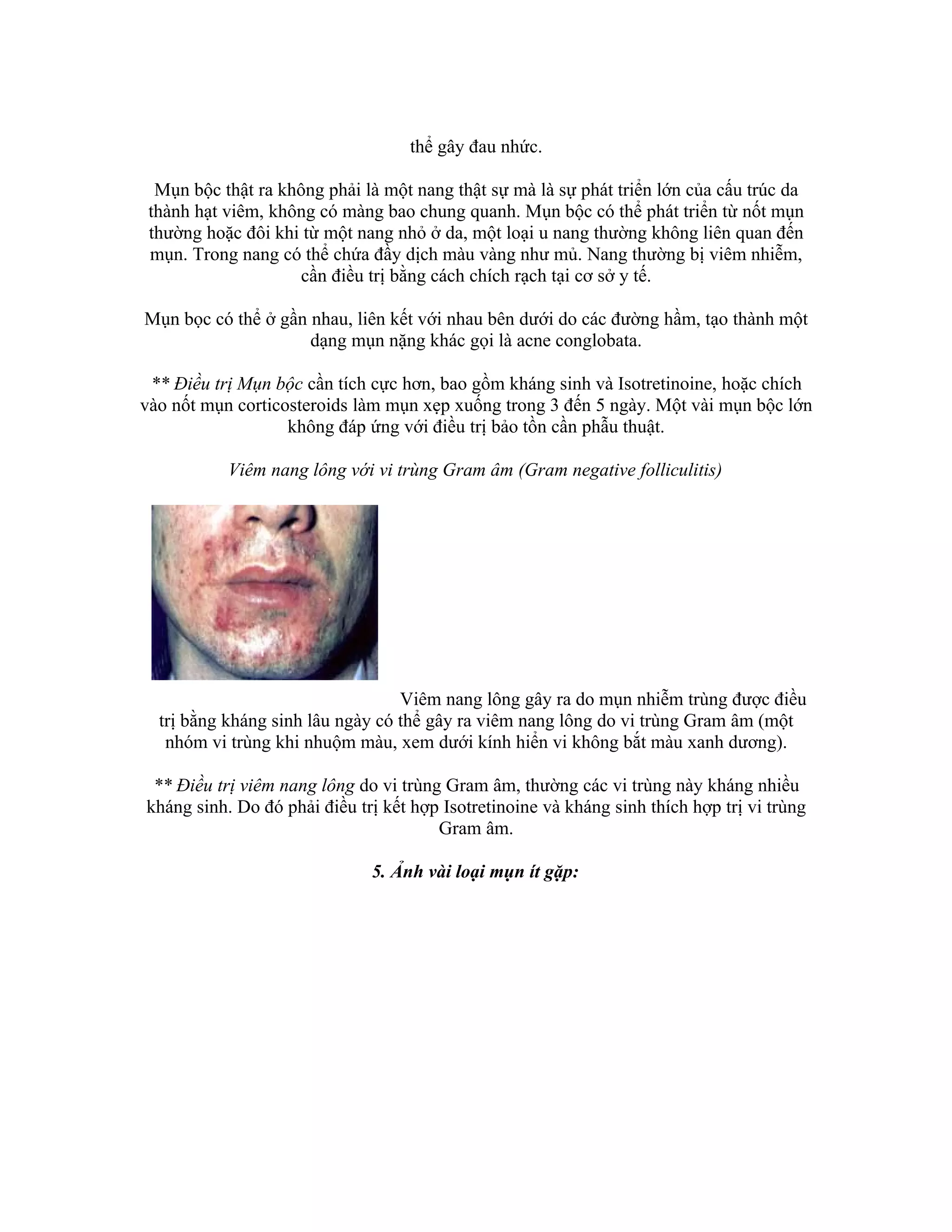 thể gây đau nhức.

  Mụn bộc thật ra không phải là một nang thật sự mà là sự phát triển lớn của cấu trúc da
 thành hạt viêm, không có màng bao chung quanh. Mụn bộc có thể phát triển từ nốt mụn
 thường hoặc đôi khi từ một nang nhỏ ở da, một loại u nang thường không liên quan đến
 mụn. Trong nang có thể chứa đầy dịch màu vàng như mủ. Nang thường bị viêm nhiễm,
                    cần điều trị bằng cách chích rạch tại cơ sở y tế.

Mụn bọc có thể ở gần nhau, liên kết với nhau bên dưới do các đường hầm, tạo thành một
                     dạng mụn nặng khác gọi là acne conglobata.

 ** Điều trị Mụn bộc cần tích cực hơn, bao gồm kháng sinh và Isotretinoine, hoặc chích
vào nốt mụn corticosteroids làm mụn xẹp xuống trong 3 đến 5 ngày. Một vài mụn bộc lớn
                   không đáp ứng với điều trị bảo tồn cần phẫu thuật.

           Viêm nang lông với vi trùng Gram âm (Gram negative folliculitis)




                                  Viêm nang lông gây ra do mụn nhiễm trùng được điều
  trị bằng kháng sinh lâu ngày có thể gây ra viêm nang lông do vi trùng Gram âm (một
   nhóm vi trùng khi nhuộm màu, xem dưới kính hiển vi không bắt màu xanh dương).

 ** Điều trị viêm nang lông do vi trùng Gram âm, thường các vi trùng này kháng nhiều
kháng sinh. Do đó phải điều trị kết hợp Isotretinoine và kháng sinh thích hợp trị vi trùng
                                       Gram âm.

                              5. Ảnh vài loại mụn ít gặp:
 