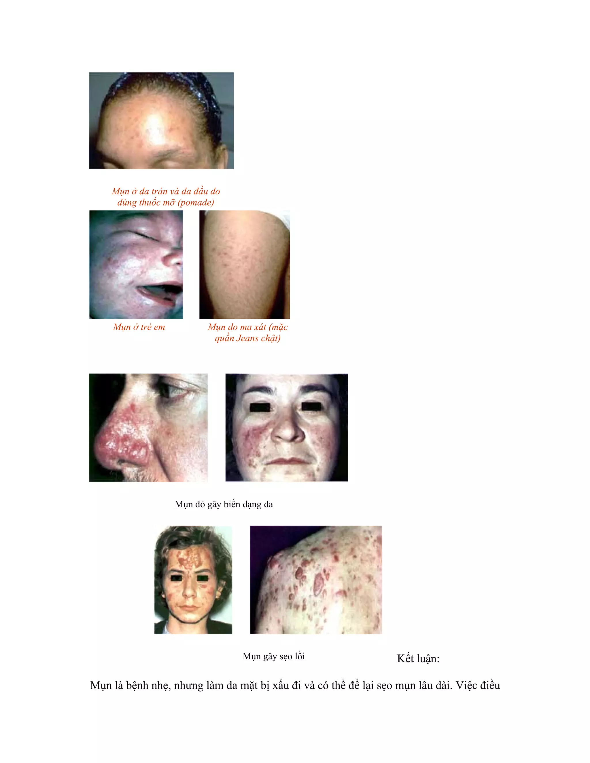 Mụn ở da trán và da đầu do
         dùng thuốc mỡ (pomade)




        Mụn ở trẻ em           Mụn do ma xát (mặc
                                quần Jeans chật)
_____




                       Mụn đỏ gây biến dạng da




                                      Mụn gây sẹo lồi            Kết luận:

Mụn là bệnh nhẹ, nhưng làm da mặt bị xấu đi và có thể để lại sẹo mụn lâu dài. Việc điều
 