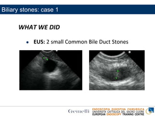 ENDOSCOPIA DIGESTIVA CHIRURGICA
UNIVERSITA’ CATTOLICA DEL SACRO CUORE
EUROPEAN ENDOSCOPY TRAINING CENTRE
WHAT WE DID
 EUS: 2 small Common Bile Duct Stones
3.2 mm
Biliary stones: case 1
 
