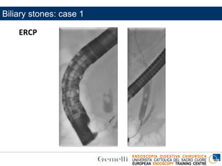 ENDOSCOPIA DIGESTIVA CHIRURGICA
UNIVERSITA’ CATTOLICA DEL SACRO CUORE
EUROPEAN ENDOSCOPY TRAINING CENTRE
ERCP
Biliary stones: case 1
 