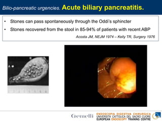 ENDOSCOPIA DIGESTIVA CHIRURGICA
UNIVERSITA’ CATTOLICA DEL SACRO CUORE
EUROPEAN ENDOSCOPY TRAINING CENTRE
• Stones can pass spontaneously through the Oddi’s sphincter
• Stones recovered from the stool in 85-94% of patients with recent ABP
Acosta JM, NEJM 1974 – Kelly TR, Surgery 1976
Bilio-pancreatic urgencies. Acute biliary pancreatitis.
 
