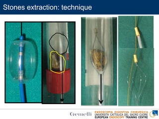 ENDOSCOPIA DIGESTIVA CHIRURGICA
UNIVERSITA’ CATTOLICA DEL SACRO CUORE
EUROPEAN ENDOSCOPY TRAINING CENTRE
Stones extraction: technique
 