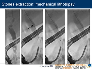 ENDOSCOPIA DIGESTIVA CHIRURGICA
UNIVERSITA’ CATTOLICA DEL SACRO CUORE
EUROPEAN ENDOSCOPY TRAINING CENTRE
Stones extraction: mechanical lithotripsy
 