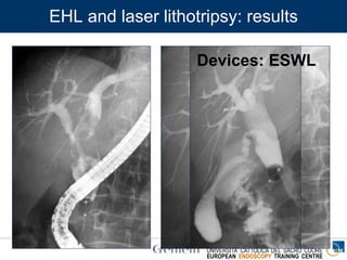 ENDOSCOPIA DIGESTIVA CHIRURGICA
UNIVERSITA’ CATTOLICA DEL SACRO CUORE
EUROPEAN ENDOSCOPY TRAINING CENTRE
Devices: ESWL
EHL and laser lithotripsy: results
 