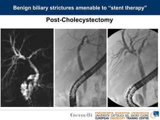 ENDOSCOPIA DIGESTIVA CHIRURGICA
UNIVERSITA’ CATTOLICA DEL SACRO CUORE
EUROPEAN ENDOSCOPY TRAINING CENTRE
Post-Cholecystectomy
Benign biliary strictures amenable to “stent therapy”
 