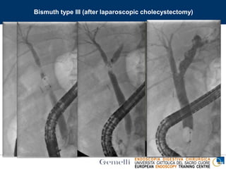 ENDOSCOPIA DIGESTIVA CHIRURGICA
UNIVERSITA’ CATTOLICA DEL SACRO CUORE
EUROPEAN ENDOSCOPY TRAINING CENTRE
Bismuth type III (after laparoscopic cholecystectomy)
4 6
 