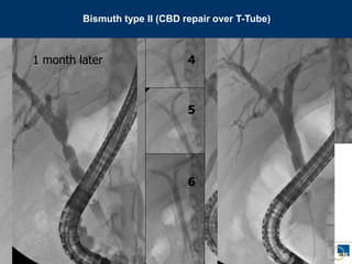 ENDOSCOPIA DIGESTIVA CHIRURGICA
UNIVERSITA’ CATTOLICA DEL SACRO CUORE
EUROPEAN ENDOSCOPY TRAINING CENTRE
Dig. End. Unit - UCSC – Rome - Italy
4
5
6
1 month later
Bismuth type II (CBD repair over T-Tube)
 