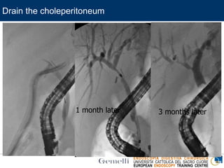 ENDOSCOPIA DIGESTIVA CHIRURGICA
UNIVERSITA’ CATTOLICA DEL SACRO CUORE
EUROPEAN ENDOSCOPY TRAINING CENTRE
Drain the choleperitoneum
1 month later 3 months later
 