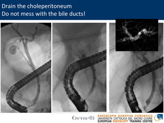 ENDOSCOPIA DIGESTIVA CHIRURGICA
UNIVERSITA’ CATTOLICA DEL SACRO CUORE
EUROPEAN ENDOSCOPY TRAINING CENTRE
Drain the choleperitoneum
Do not mess with the bile ducts!
 