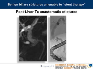 ENDOSCOPIA DIGESTIVA CHIRURGICA
UNIVERSITA’ CATTOLICA DEL SACRO CUORE
EUROPEAN ENDOSCOPY TRAINING CENTRE
Post-Liver Tx anastomotic stictures
Benign biliary strictures amenable to “stent therapy”
 