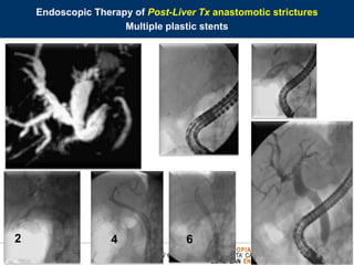 ENDOSCOPIA DIGESTIVA CHIRURGICA
UNIVERSITA’ CATTOLICA DEL SACRO CUORE
EUROPEAN ENDOSCOPY TRAINING CENTRE
2 5 74 6
Endoscopic Therapy of Post-Liver Tx anastomotic strictures
Multiple plastic stents
 